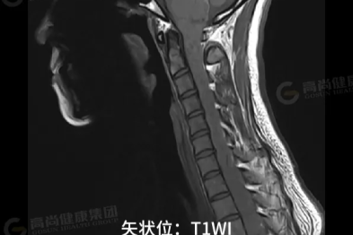 【高尚病例】室管膜瘤 1 例
