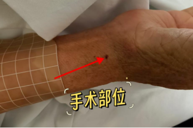 手腕处穿刺，大脑里「拆弹」
