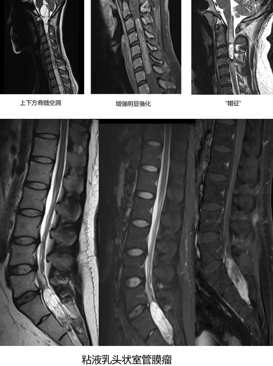 【高尚病例】室管膜瘤 1 例