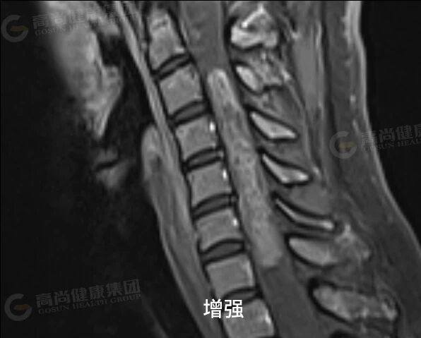 【高尚病例】室管膜瘤 1 例