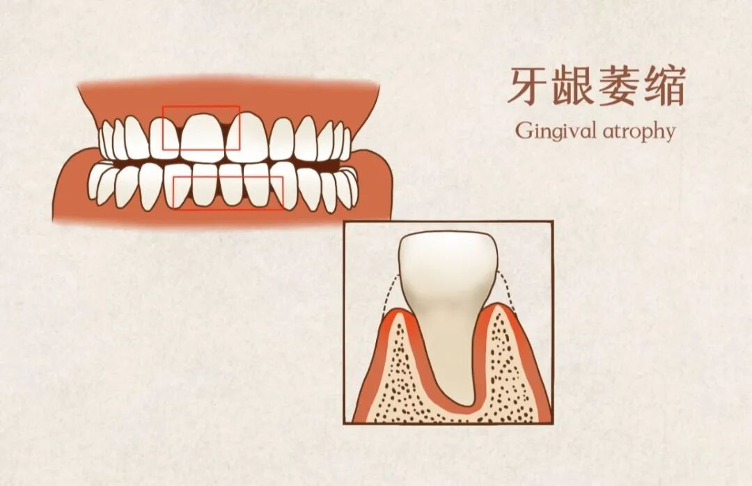 牙周炎常见误区大盘点，90% 的人都踩过坑