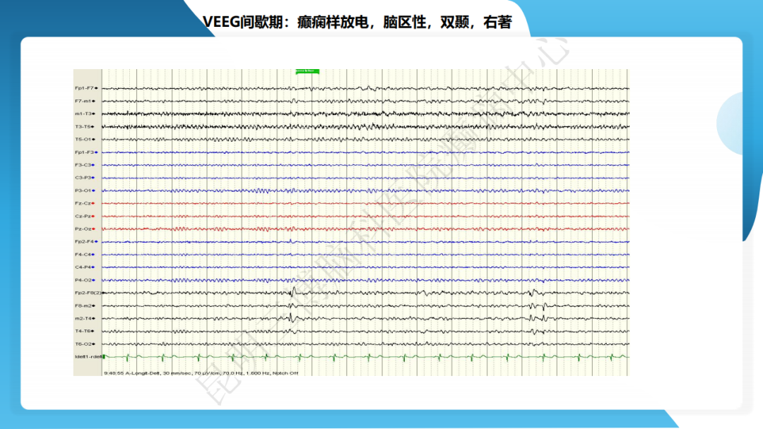 攻克难治性癫痫！右颞开颅术成功切除海绵状血管瘤，患者重归正常生活