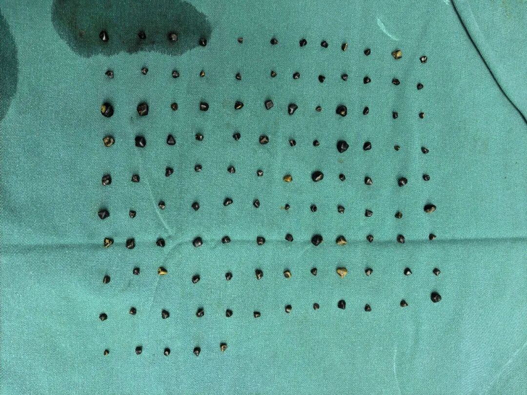 100 多颗！66 岁老人体内密密麻麻，塞满了···医生紧急提醒！