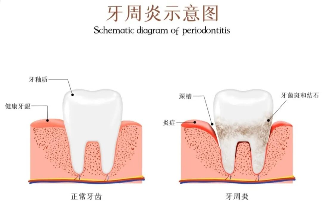 牙周炎常见误区大盘点，90% 的人都踩过坑