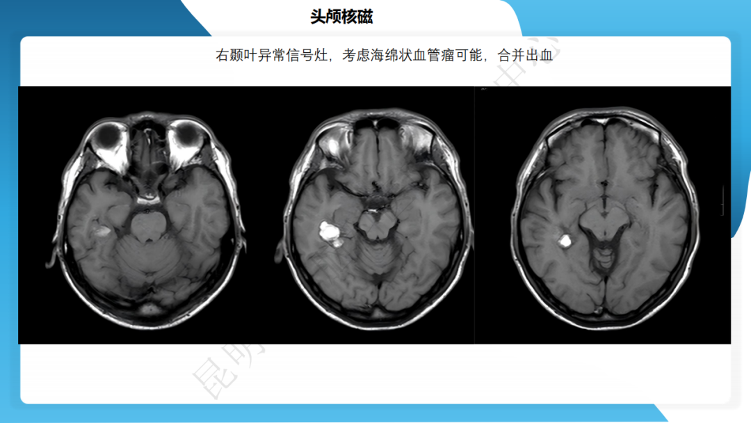 攻克难治性癫痫！右颞开颅术成功切除海绵状血管瘤，患者重归正常生活