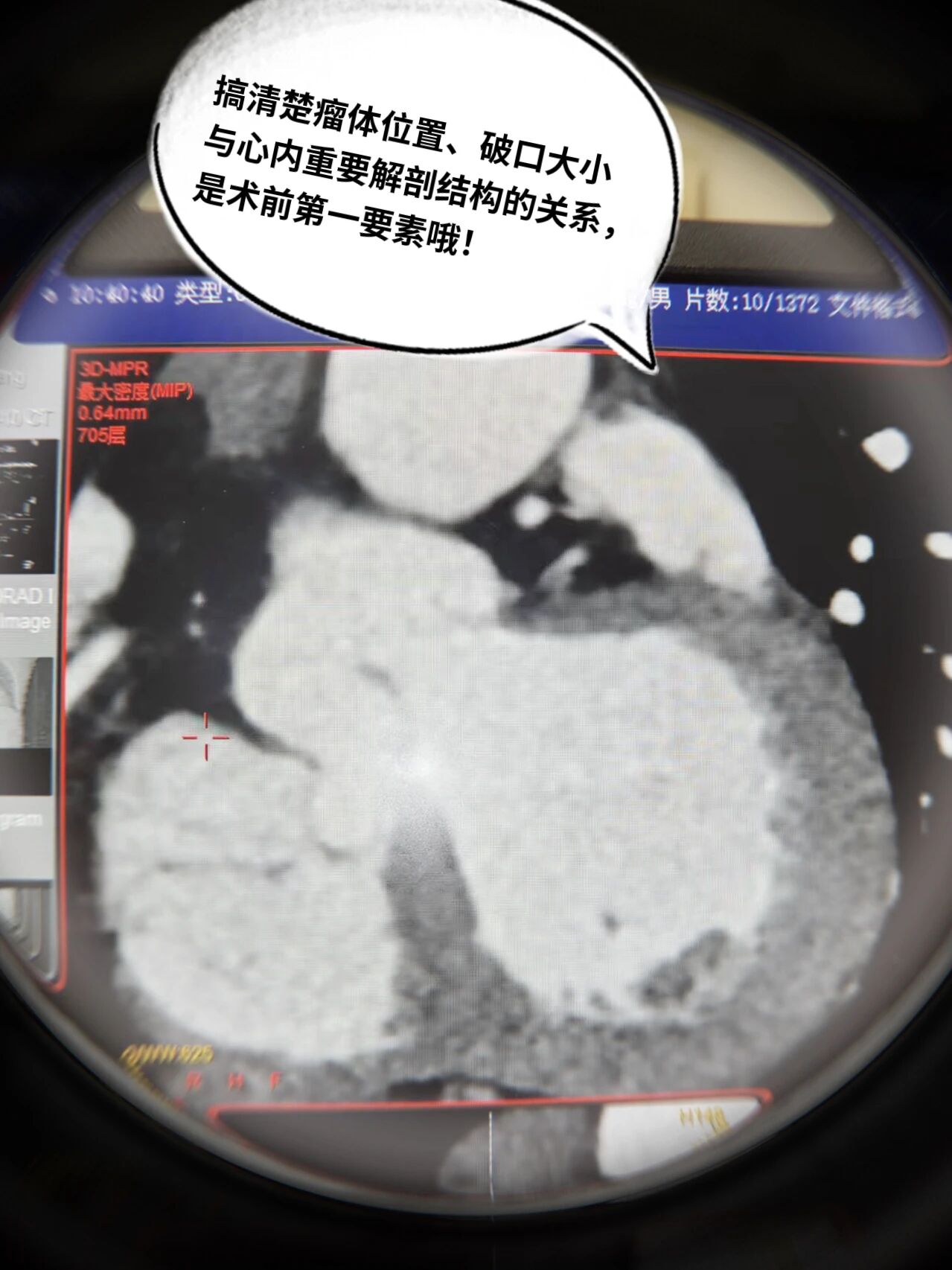 刀割胸痛别误判!这枚「心脏炸弹」更致命