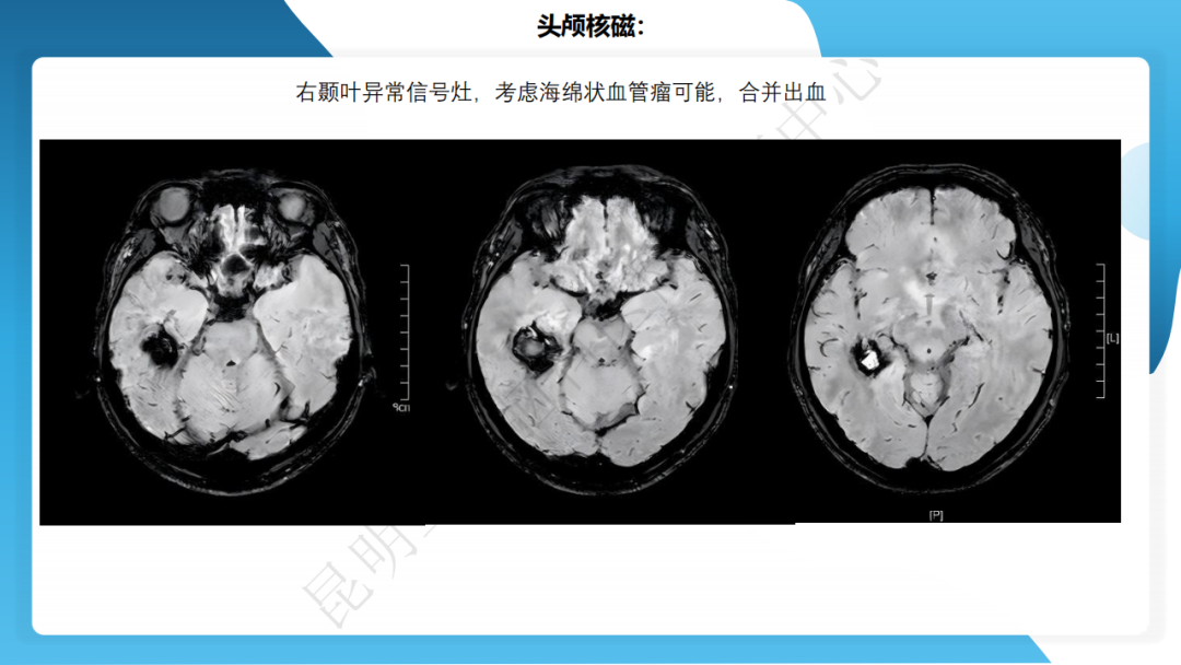 攻克难治性癫痫！右颞开颅术成功切除海绵状血管瘤，患者重归正常生活
