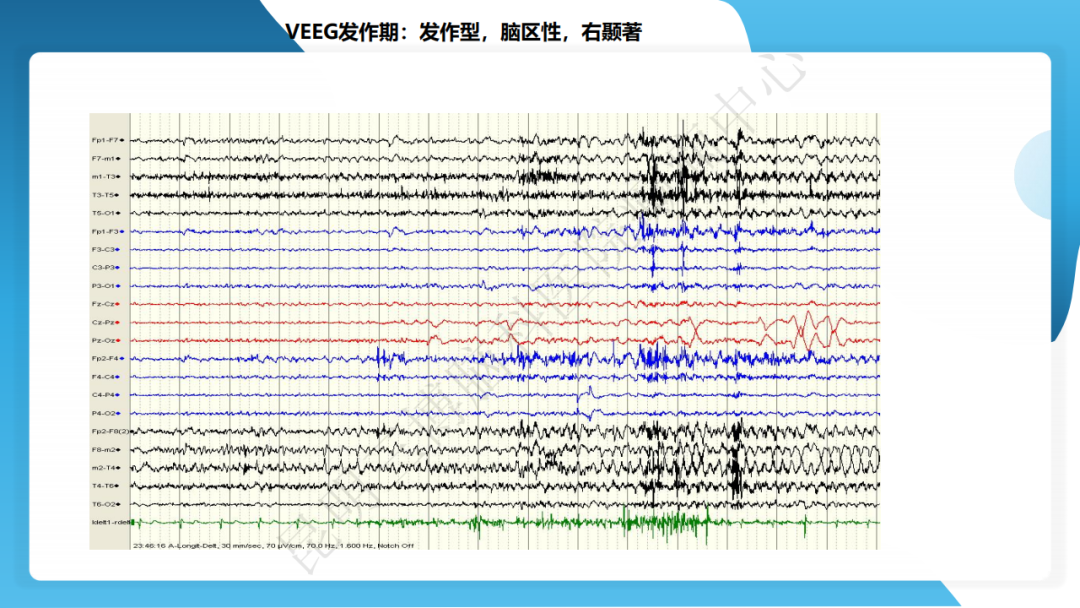 攻克难治性癫痫！右颞开颅术成功切除海绵状血管瘤，患者重归正常生活