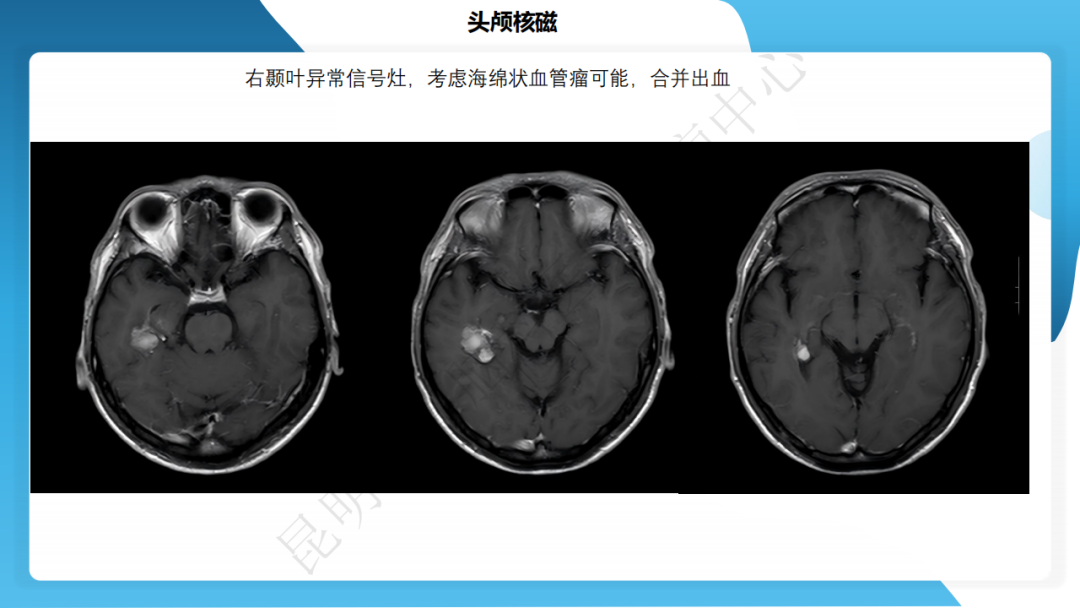 攻克难治性癫痫！右颞开颅术成功切除海绵状血管瘤，患者重归正常生活