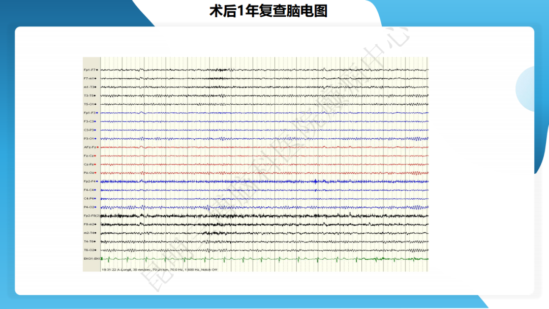攻克难治性癫痫！右颞开颅术成功切除海绵状血管瘤，患者重归正常生活