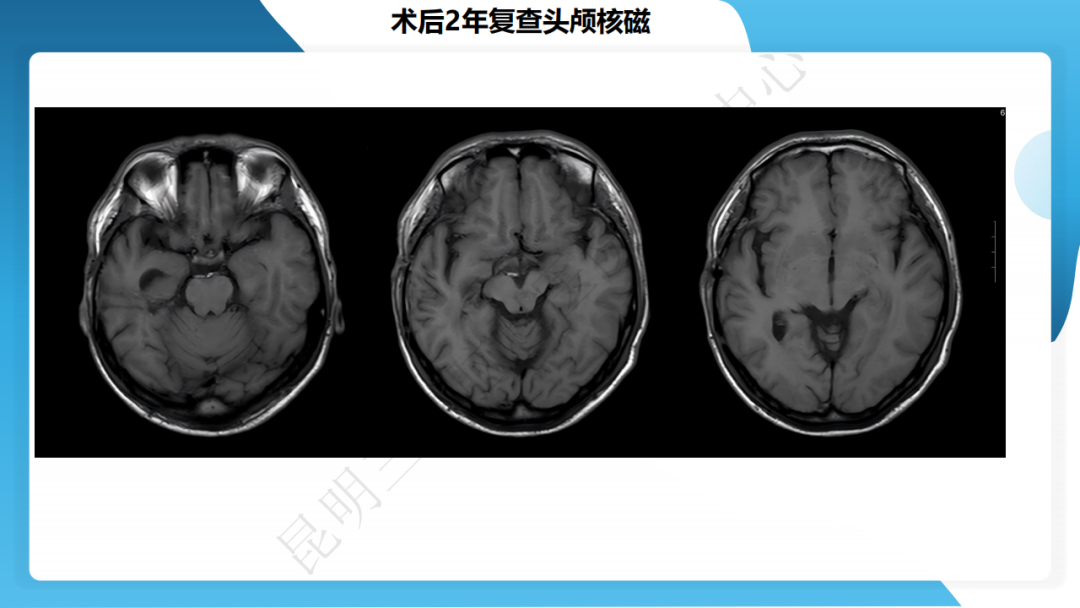 攻克难治性癫痫！右颞开颅术成功切除海绵状血管瘤，患者重归正常生活