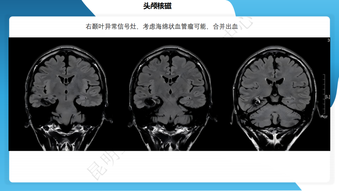 攻克难治性癫痫！右颞开颅术成功切除海绵状血管瘤，患者重归正常生活