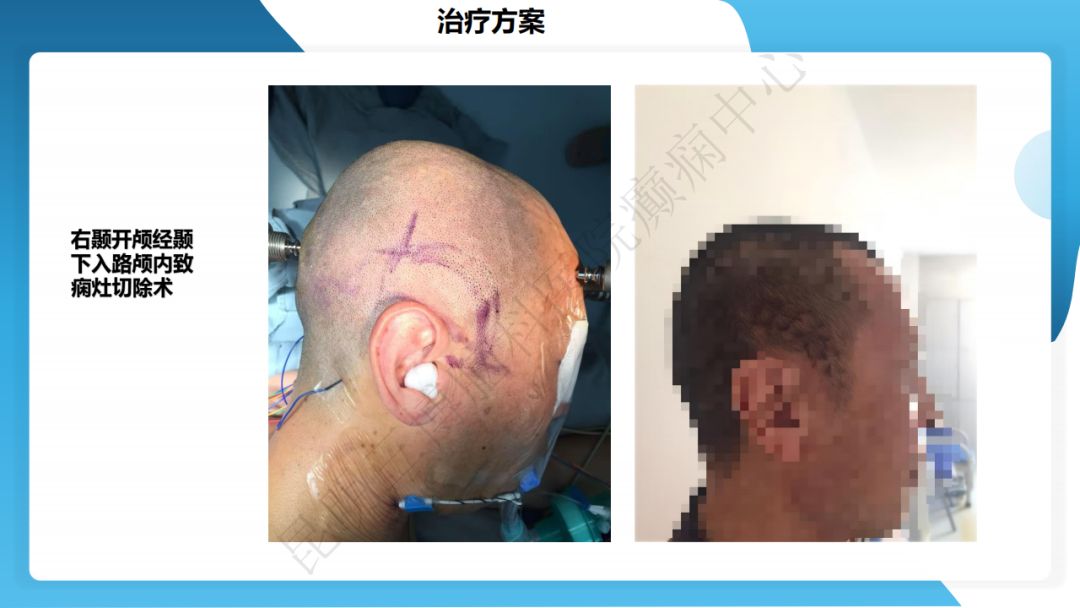 攻克难治性癫痫！右颞开颅术成功切除海绵状血管瘤，患者重归正常生活