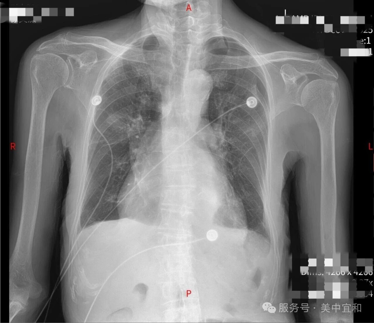 重症肺炎合并心衰,生命告急!多学科通力合作下的生命接力赛