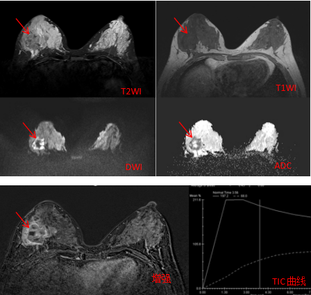 典型病例 | 妈妈的勇气与坚守：一位哺乳期女性的乳癌发现之路
