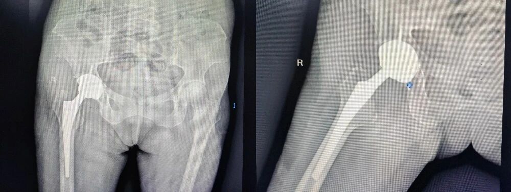 为生命重建支点,让系统性红斑狼疮患者重获行走自由