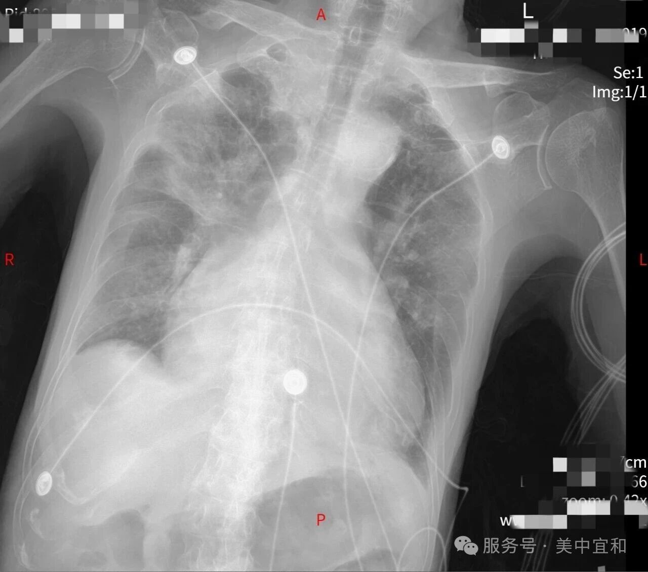 重症肺炎合并心衰,生命告急!多学科通力合作下的生命接力赛