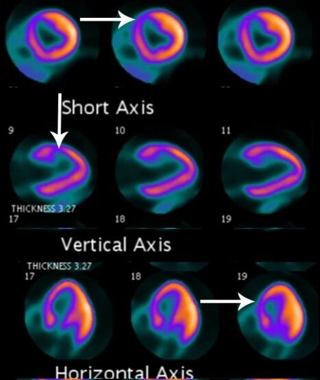 心脏检查进入高清时代！PET/CT 核素心肌灌注显像，让心脏问题看得更清、更准
