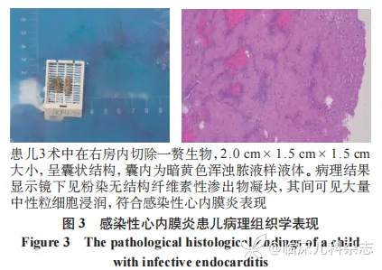 肺炎支原体肺炎继发儿童感染性心内膜炎临床特征与诊治分析