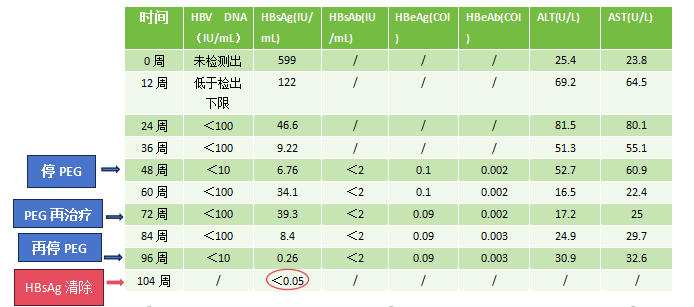 母婴乙肝肝硬化患者，干扰素间歇治疗后实现临床治愈！