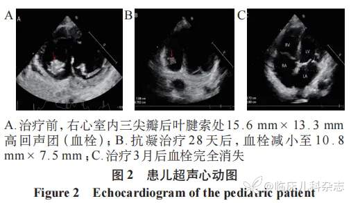 病例儿童重症肺炎支原体肺炎合并心脏内血栓的临床特征与预后:一项单中心回顾性研究