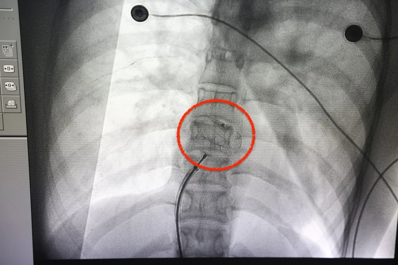 高中生频繁晕倒，竟是心脏藏了「大漏洞」！这些预警信号，很多人都没当回事