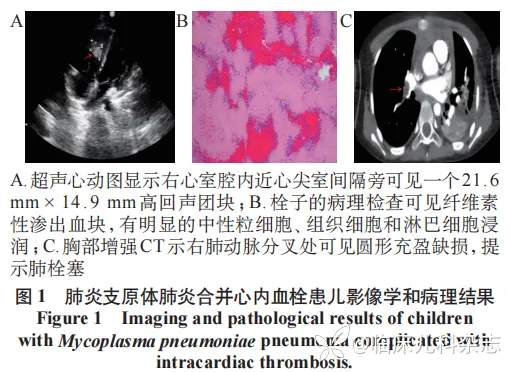 病例儿童重症肺炎支原体肺炎合并心脏内血栓的临床特征与预后:一项单中心回顾性研究