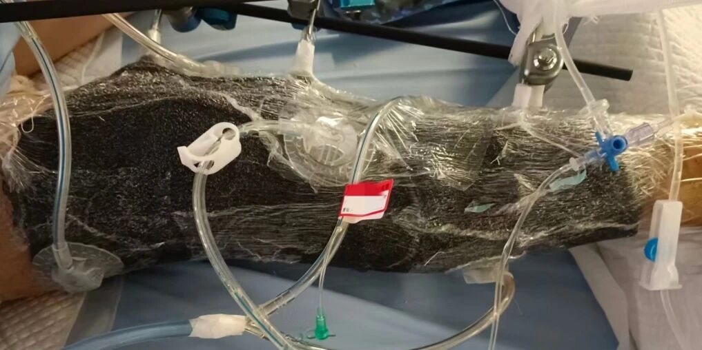 重度脱套伤险截肢！正兴医院骨三科全力保肢成功