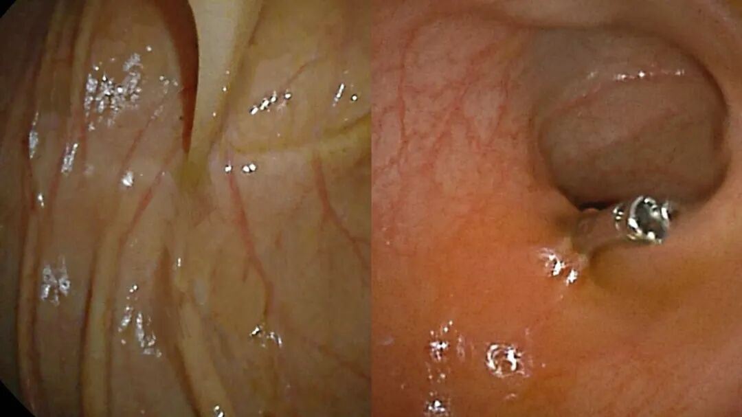 突破!南大二附院消化内科肠病组成功实施「单侧进镜全小肠贯通检查」