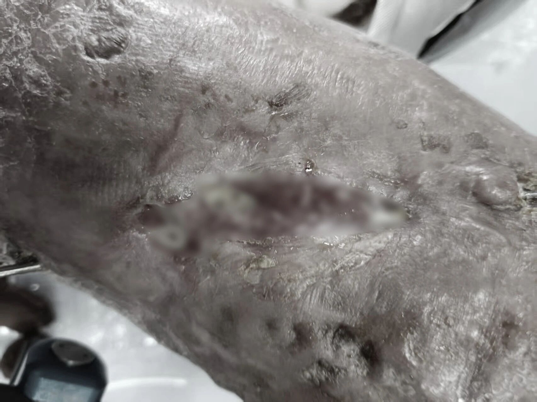 重度脱套伤险截肢！正兴医院骨三科全力保肢成功