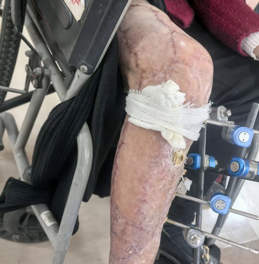 重度脱套伤险截肢！正兴医院骨三科全力保肢成功