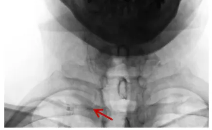 脑血管介入「新技术」 | 桡动脉入路导引导管控制「半释放技术」治疗低位椎动脉开口狭窄