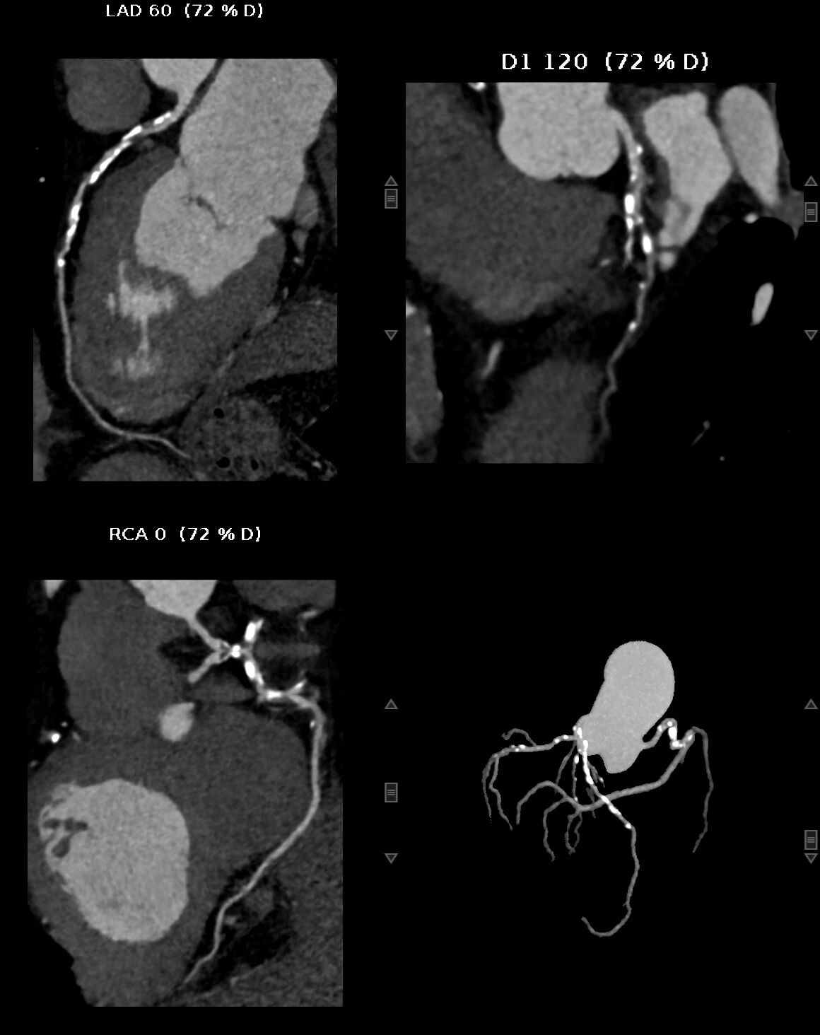 健康科普丨读懂冠脉钙化积分:心脏血管的「健康预警信号」
