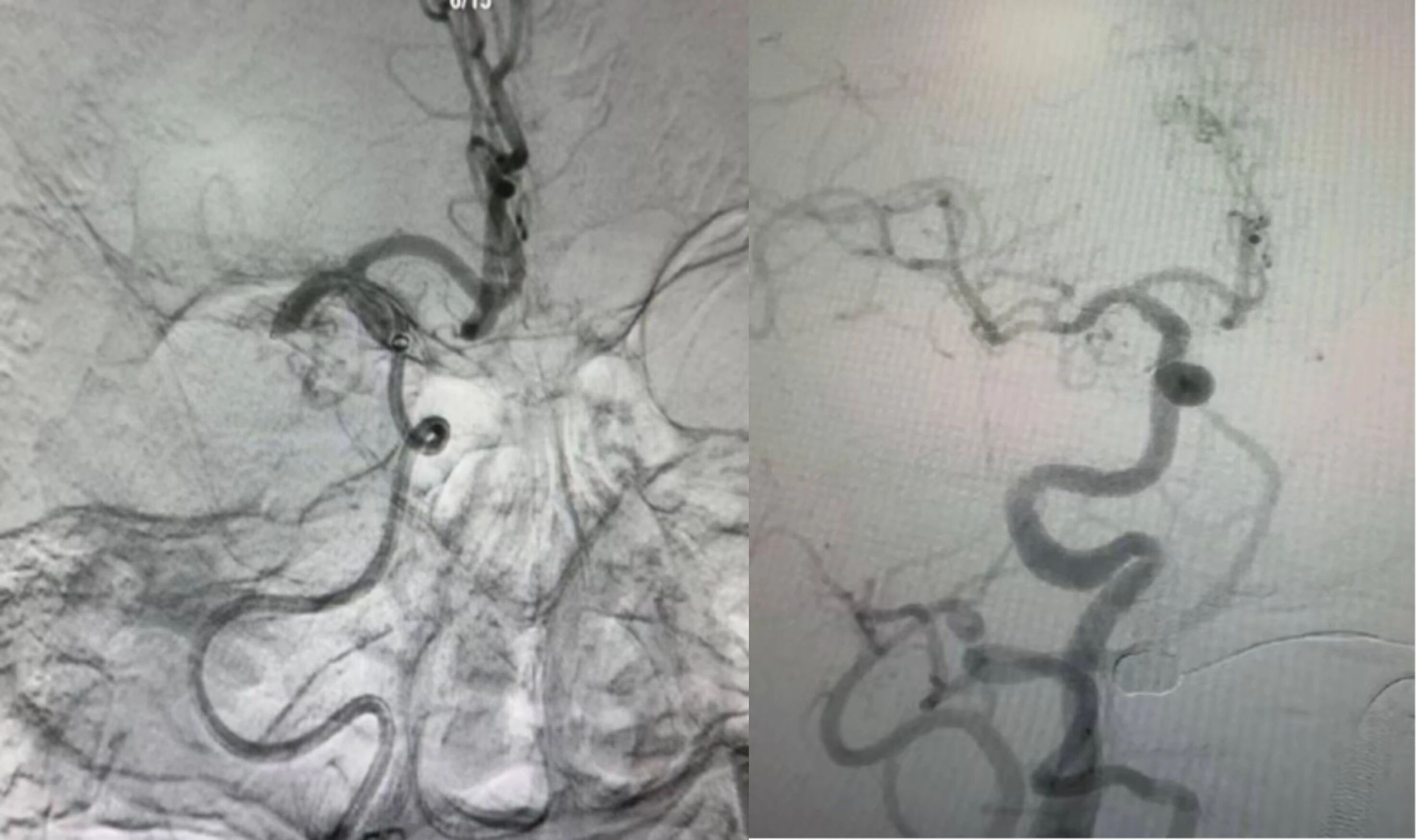 另辟蹊径 !华润武钢总医院首例经桡动脉入脑取栓术获成功