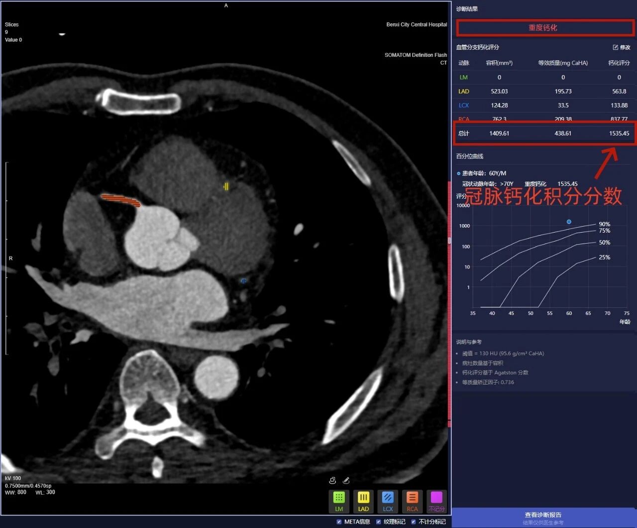 健康科普丨读懂冠脉钙化积分:心脏血管的「健康预警信号」