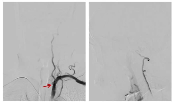 脑血管介入「新技术」 | 桡动脉入路导引导管控制「半释放技术」治疗低位椎动脉开口狭窄