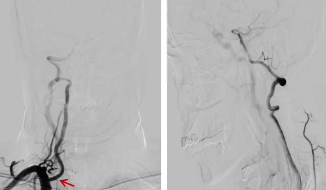 脑血管介入「新技术」 | 桡动脉入路导引导管控制「半释放技术」治疗低位椎动脉开口狭窄