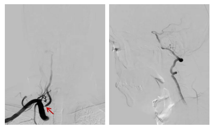 脑血管介入「新技术」 | 桡动脉入路导引导管控制「半释放技术」治疗低位椎动脉开口狭窄
