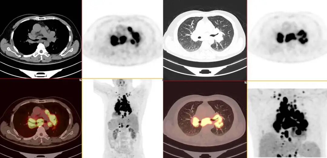 【高尚病例】结节病 PET-CT 病例分享