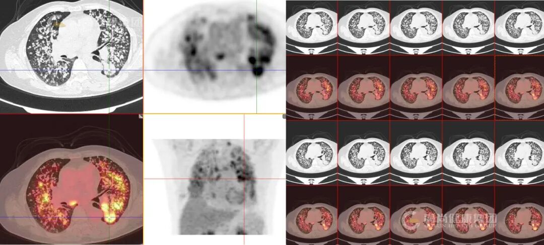 【高尚病例】结节病 PET-CT 病例分享