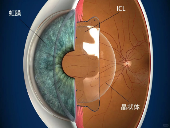 双眼屈光参差矫正：选全飞秒、半飞秒还是 ICL？关键看这几点