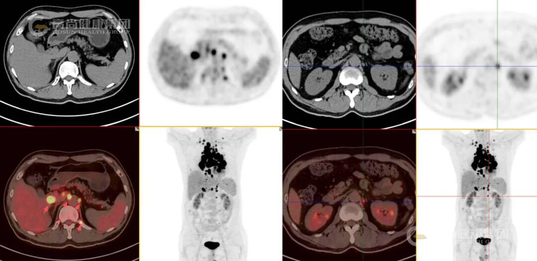 【高尚病例】结节病 PET-CT 病例分享