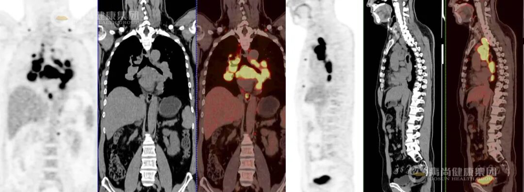 【高尚病例】结节病 PET-CT 病例分享