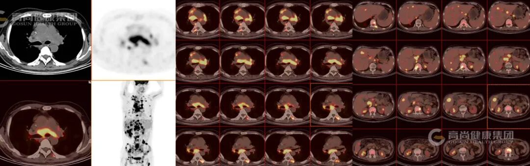 【高尚病例】结节病 PET-CT 病例分享