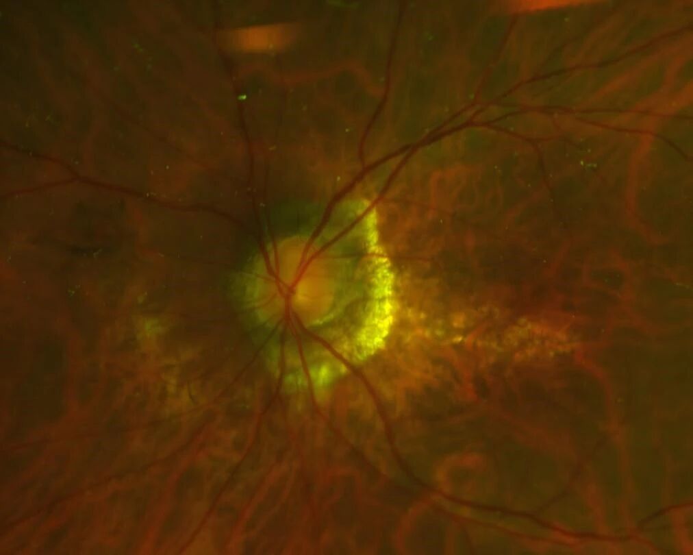 60 岁大叔突发视力骤降查无因，辽宁爱尔眼科医院葡萄膜炎专病门诊精准诊疗护光明