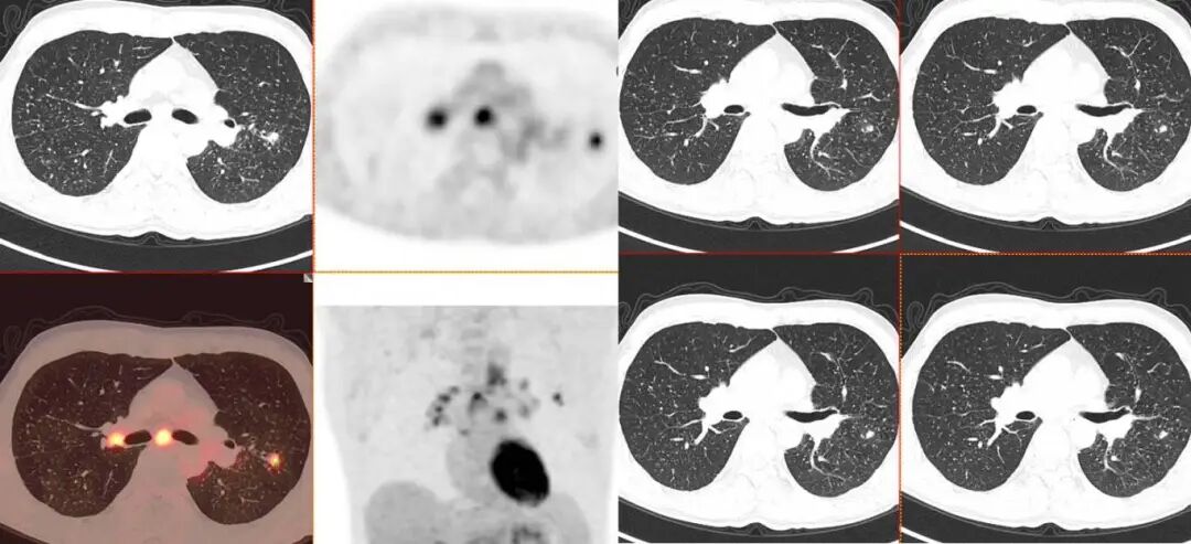【高尚病例】结节病 PET-CT 病例分享