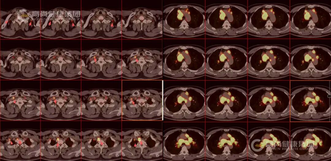 【高尚病例】结节病 PET-CT 病例分享