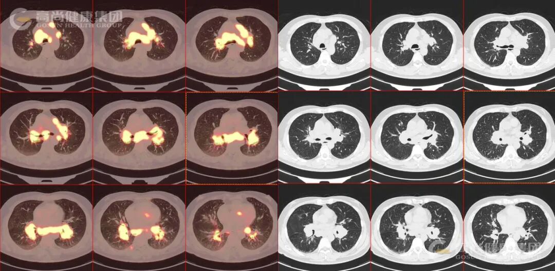 【高尚病例】结节病 PET-CT 病例分享