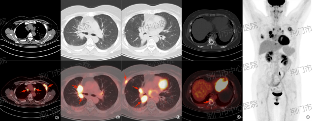 肿瘤患者复查做不做 PET/CT？这张「必要性清单」帮您答疑解惑！