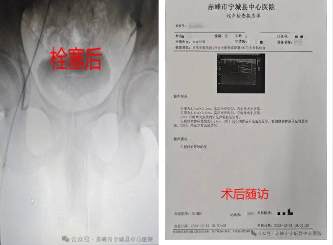 精索静脉曲张微创诊疗 助力青年圆梦军营